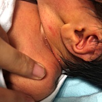 脖子上起白色泡，还越来越大，医生说唔得，但另一个医生说是毒'这到底怎样才能下去