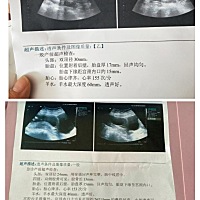 一周后复查，胎盘上移15mm，医生说可以上班了，不能太累。