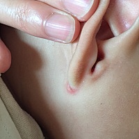 为什么我宝贝的耳垂下面老是要这样裂开，像个小口子，会很痒，他总是自己抓耳朵，把耳朵都刨出血了