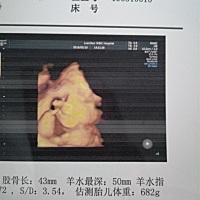 今天做的四维彩超就是看不清宝贝的小脸和眼睛，还说脐带绕颈一周了，会不会很严重。
