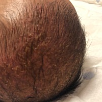 宝宝头上好多黄色结痂，今天晚上又发红又流黄水，还痒，好像更严重了，之前洗掉了再长出来，听说是正常...