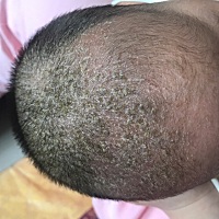 新生儿剃完头后有结痂没有马上洗掉，用了两次麻油洗头都结痂粘在一起弄都弄不掉，宝妈们有啥好办法