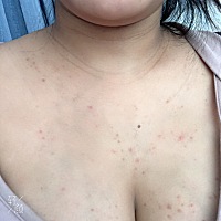 想问下大家，胸前长了一片红疙瘩，怀孕以后长得，有时候有点痒怎么回事，有这样的吗，有什么办法消...