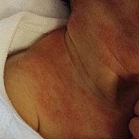 宝妈们帮忙看看宝宝脖子上是什么，怎么才能好，急等大家回复，谢谢大家了，看着好心疼啊真的，昨晚宝宝...