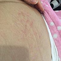 很神奇？我嫂子给我酸凝胶和酸原液，生完孩子我才摸三天减轻了好多？黑色纹几乎不黑了，粉色的纹淡了好...