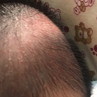 宝宝胎垢太顽固，今天洗掉第二天又长出来，宝宝经常用手挠，着急死了，不知道她是痒还是杂