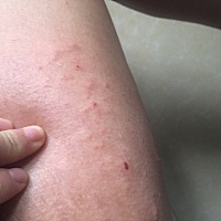 孕33周突然肚皮妊娠纹痒，结果没过一两天就全身开始一大片的痒，百度说是慢性荨麻疹，也不知道是不是。...
