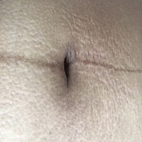 产后肚子成这样子了，这个纹会收回去吗？有什么产品可以去除这个纹的？