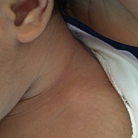 宝妈们知道这是咋回事吗？发现孩子锁骨这，感觉多个骨头，凸出来，右边没有，按，摸宝宝没反应，不疼，...