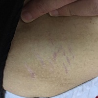 为什么生完才长纹啊，有孕妈这样的么？怀孕时没有一点纹，现在生完二十多天了生前140现在117.这几天纹开...