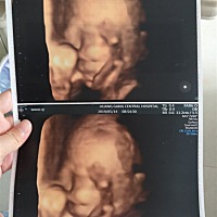 三维彩超显示宝宝双肾集合系统分离，左侧分离0.34CM，右侧分离0.20CM，听说是宝宝在憋尿，可能是男宝 宝...