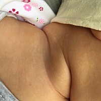 宝宝脖子有湿疹，医生给开了擦的药。擦过是好了。可是这印子让人揪心。能不能褪去啊？？？？怎么会留下...