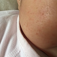 这两天脸上长这么多东西，有没有宝妈知道这是什么啊，抹什么管用，右边脸上比左边多，最近宝宝喜欢吃手...