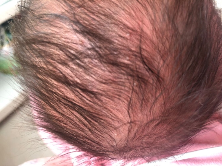 请问下有没有知道28天的宝宝头皮里长了一些小白点是什么东西的宝妈？