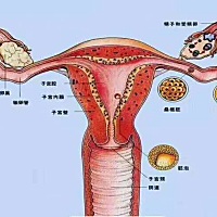 ❤❤  如果你生完孩子后还长期痛经，那你子宫肌瘤是跑不了的，高达95%。 还有5%的女性就是在来例假的时...