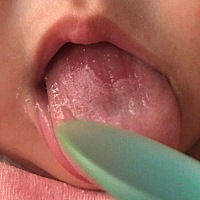 宝贝7个月了，在5个月左右的时候发现舌头深处舌苔没皮，生下来的时候确定没有，是后来长起来的，宝宝并...