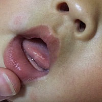 小宝的舌头有这个白点点是怎么回事呀？在线等