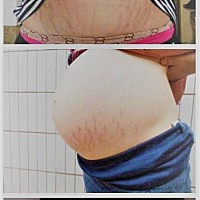 【❤️母爱的印记❤️】经过280天的骨肉相连，虽然妈妈产后努力恢复，但有些痕迹还是不可磨灭的留了...