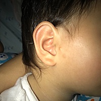 有人知道为什么耳朵边会长一个坨坨吗？一出生就有