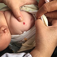 小孩好像长了血管瘤，这种情况一般治疗是激光治疗还是药物治疗的呢？有遇到相同情况的宝妈吗？