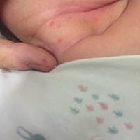 为什么我家宝宝的脸上和脖子上老是要长一些东西，脸上老是喜欢长湿疹，脖子上这个长的是什么啊？老是反...