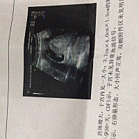 B超孕囊能看男女？