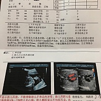 预约的八点半，整个上午做了三次，不是动的太厉害就是趴着看不全，下午两点半继续，又是看不到左手，去...