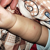 宝宝脸上长的这是什么