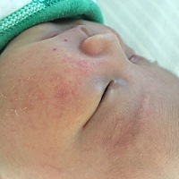 有没有宝妈知道小孩子脸这样是怎么回事，是湿疹吗？