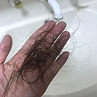 产后三个多月开始掉发，好怕自己秃顶了，请问你们都是怎么治疗