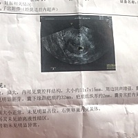 孕48天，B超居然只是疑似孕囊，也没有胎心胎芽，医生让我过一个星期复查，好担心！大家帮我看看，是不好...