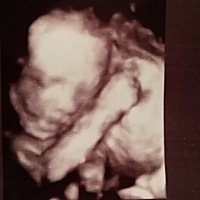 宝宝四维彩超出来了，可是脖子角度很诡异。。。大排畸看内脏器官啥的，医生都说一切正常。可脖子怎么折...