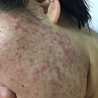 孕期长痘，产后痘痘基本消了，产后第3.4天又突然开始猛长，有没有同样经历的的妈妈分享下要怎么处理，今...