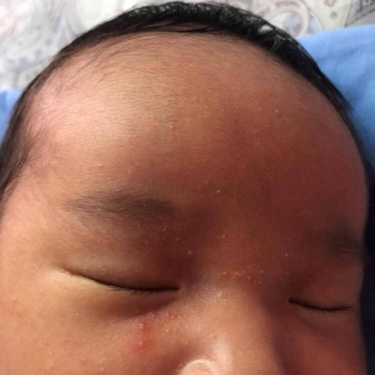 想问问各位宝妈，这种是不是属于湿疹  婴儿20天了 长这个有10来天了。这个小泡泡该怎么治能下去啊！还有好多小红点！