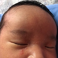 想问问各位宝妈，这种是不是属于湿疹  婴儿20天了 长这个有10来天了。这个小泡泡该怎么治能下去啊！还有...