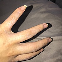 我是剖宫产，术后第二天手上起了很多皮里肉外的小疙瘩，挠挠就起水泡似的疙瘩，弄破了里面有水，身上也...