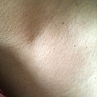 孕期扁平疣 估计是孕前就有扁平疣吧，但是当时不知道，因为很少。怀孕三个月昨天突然大爆发一样，去三家...