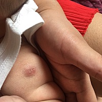 两个多月孩子打针的地方流脓了，就是出生打针的地方。现在这个样子正常么？？