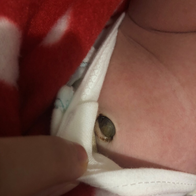 宝宝是5.1出生的 今天20号脐带‘这个状态正常吗 脐带一般多久掉