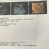 今天nt一次过。医生没说什么，应该算正常吧？但是想知道男孩女孩，现在能看出吗？