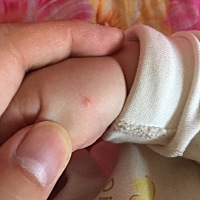 5个多月的宝宝，近期脸上，手上，腿上起了红点点，有同样出现这种情况的吗？是什么原因呀？