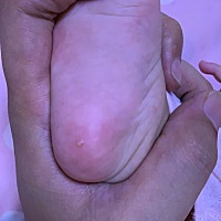 有人知道这个是什么吗？手上和脚上都有一点，宝宝快5个月了。