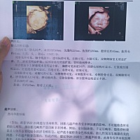 四维彩超照出来鼻子嘴巴好大 感觉宝宝好丑啊 好担心 会不会生出来鼻子嘴巴这么大啊