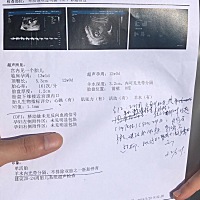 我老婆第一次42天做B超的时候显示一个孕囊，都是正常的。今天做NT的结果显示有两个孕囊，一个发育正常的...