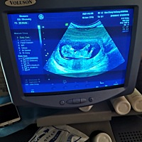 做NT时照的 有没有能看懂图的大神 帮我看看是弟弟还是妹妹 我自己看起好像是个弟弟 不知道怎么看