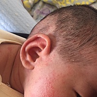宝宝脸上是痱子还是湿疹啊？