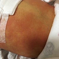 急啊！求助各位宝妈帮我看看这是什么疹啊 才刚出生两天 发现肚子背上脸上都长有 由于不知道什么情况不敢...