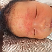 宝宝湿疹好严重，好心蕉，医生说还没满月，不让用药膏，说有激素！可是就这样不管么？到底该怎么办啊！！！