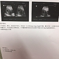 有会看孕囊数据的吗？ 有会看孕囊数据的吗？我想知道这个是男宝宝还是女宝宝