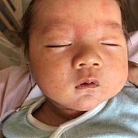 各位宝妈 都帮忙看下 宝宝脸上是什么 怎样才能快速下去